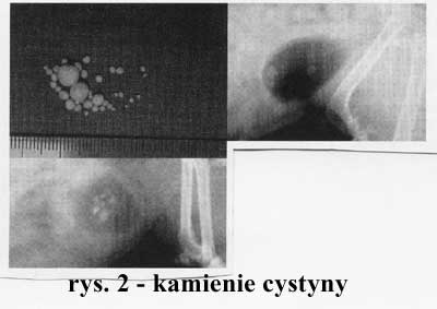 cyst2