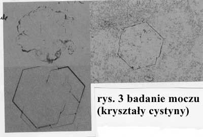 cyst3